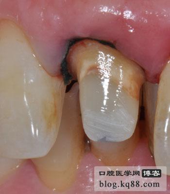 桩核贵金属(金属桩核取模方法)